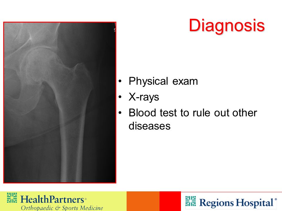 Diagnosis Physical exam X-rays Blood test to rule out other diseases