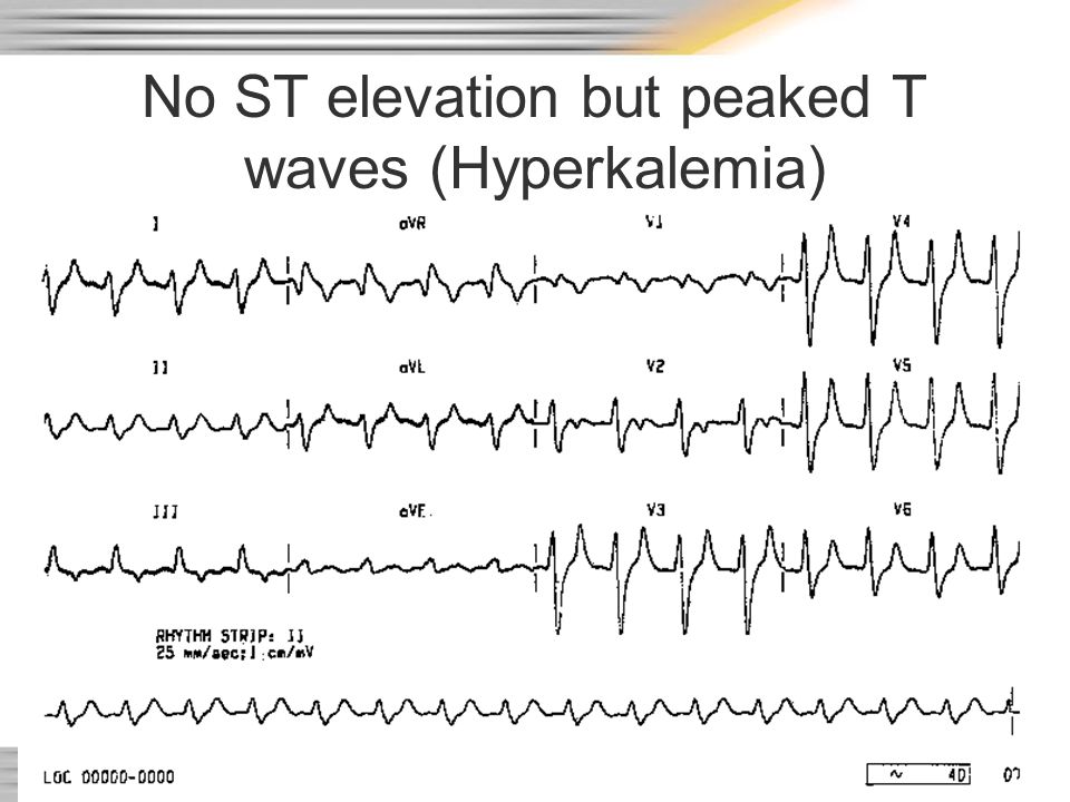 No ST elevation but peaked T waves (Hyperkalemia)