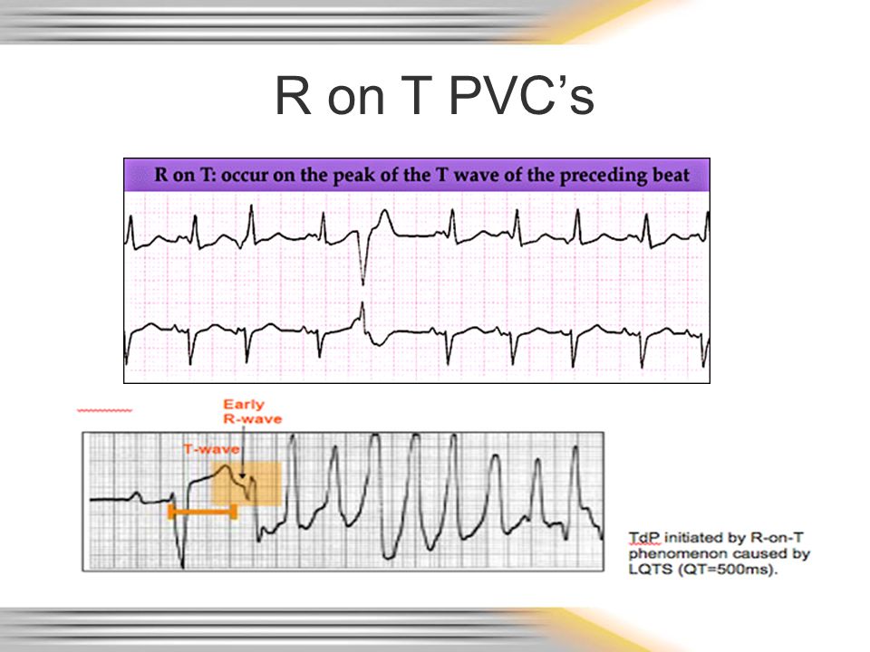 R on T PVC’s TdP – Torsades de Pointes. QRS is wide, > 0.12 seconds, and bizarre with a rate often over 150 beats per minute.