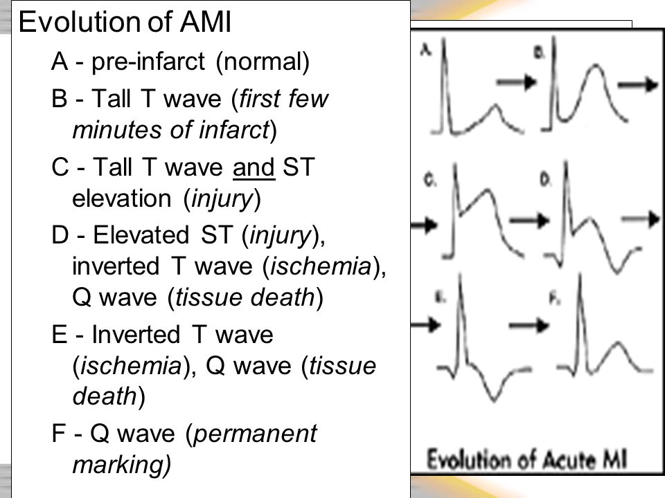 Rhythm & 12 Lead EKG Review - ppt video online download