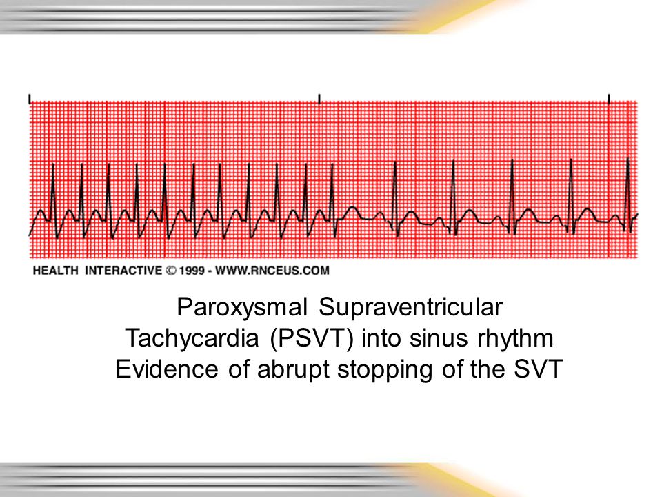 Paroxysmal Supraventricular Tachycardia (PSVT) into sinus rhythm