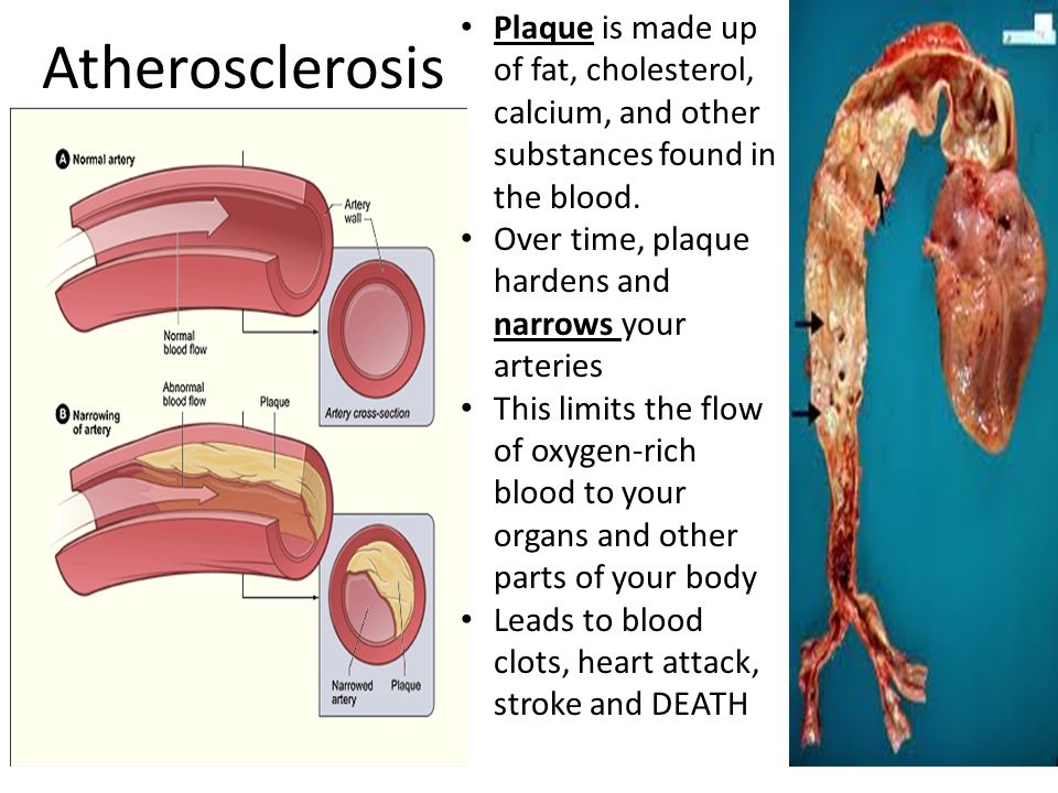 Atherosclerosis Plaque is made up of fat, cholesterol, calcium, and other substances found in the blood.