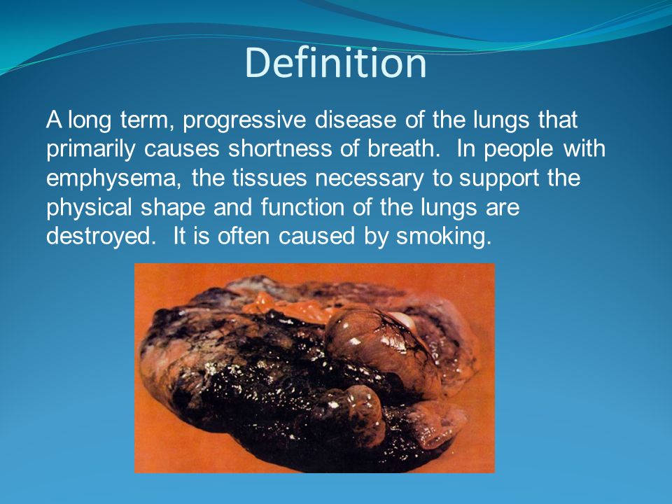 EMPHYSEMA By: Jessica S., Forster A., and Zach D.. - ppt download