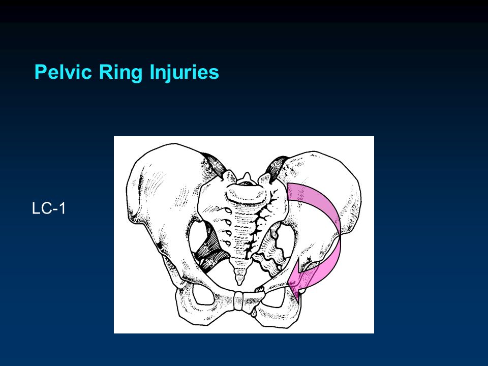 Presentation on theme: "Pelvic Ring Injuries Classification of Pelvic ...