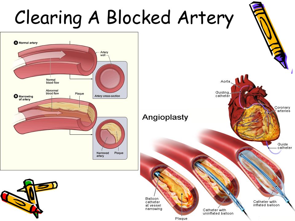 Clearing A Blocked Artery
