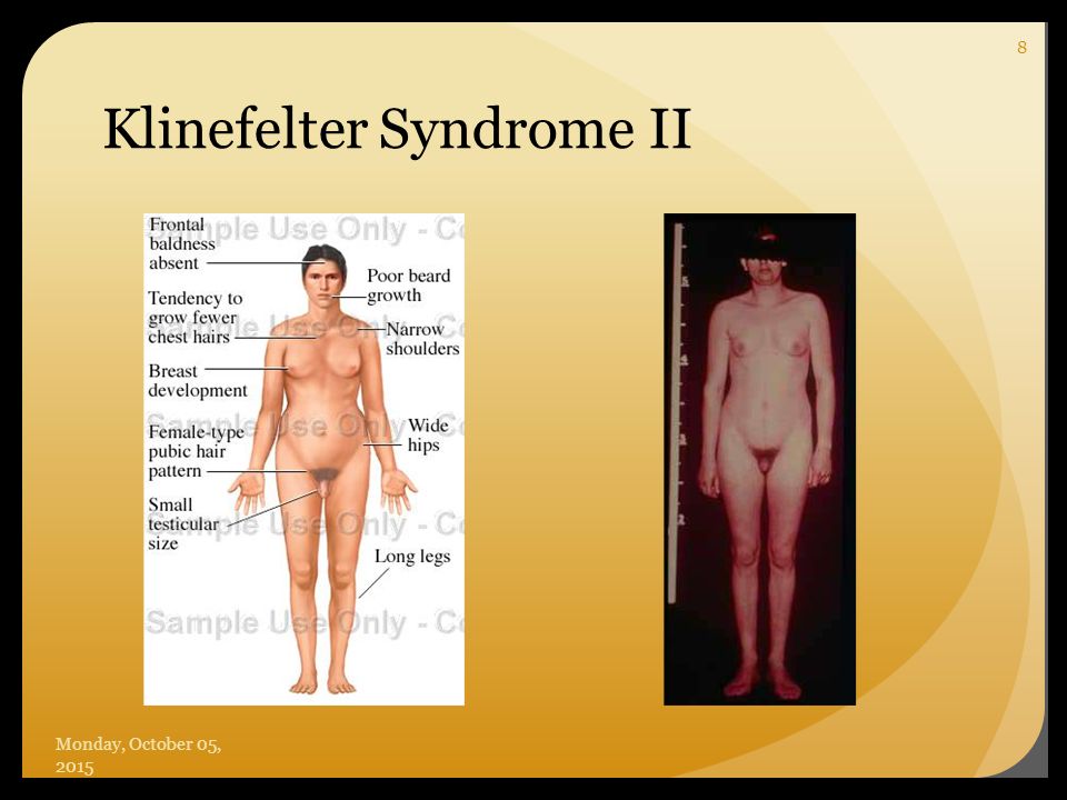 Non Disjunction Aneuploidy Abnormalities In Chromosome