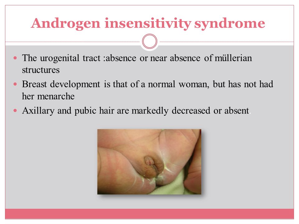 Androgen insensitivity syndrome.