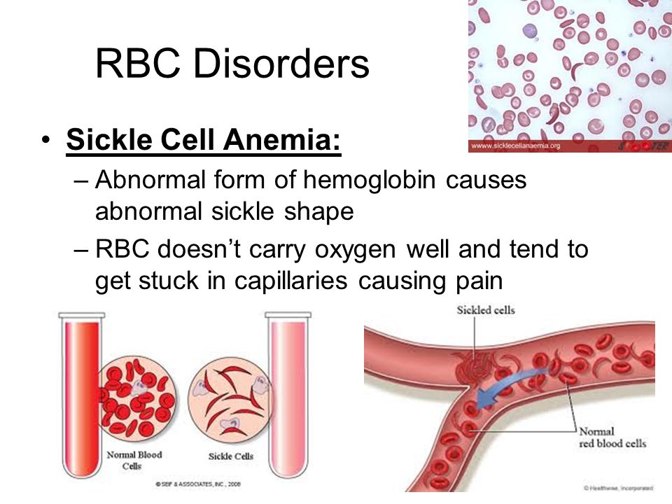 RBC Disorders Sickle Cell Anemia.