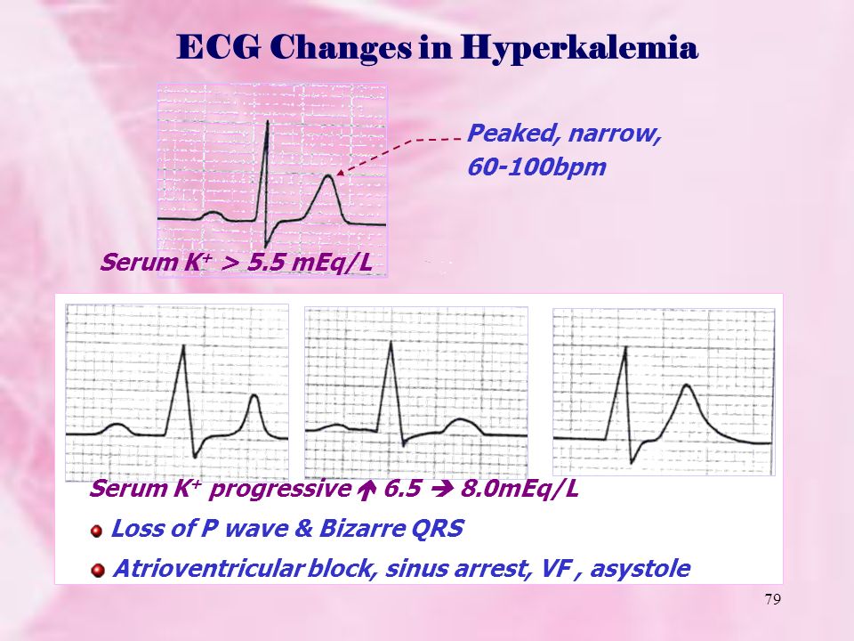 ECG Changes in Hyperkalemia.