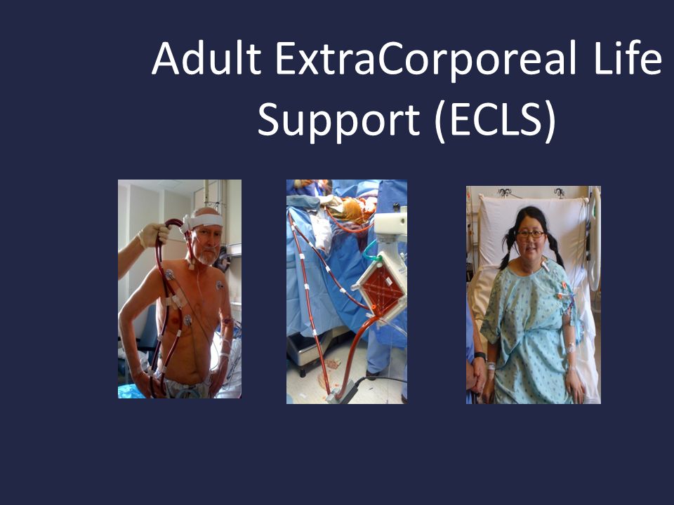 Adult ExtraCorporeal Life Support (ECLS)