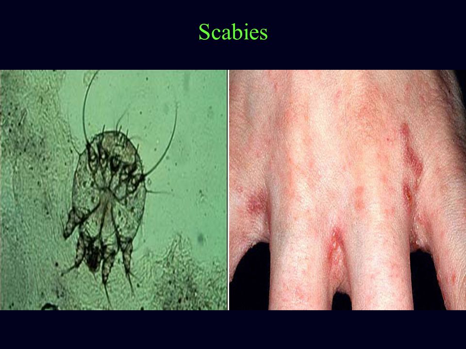 Scabies.