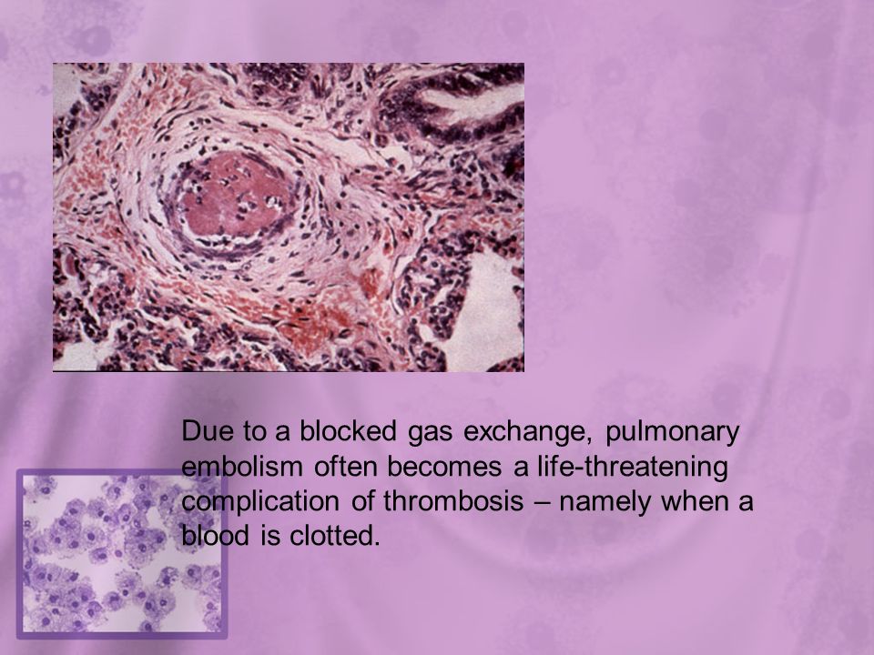 Due to a blocked gas exchange, pulmonary embolism often becomes a life-threatening complication of thrombosis – namely when a blood is clotted.