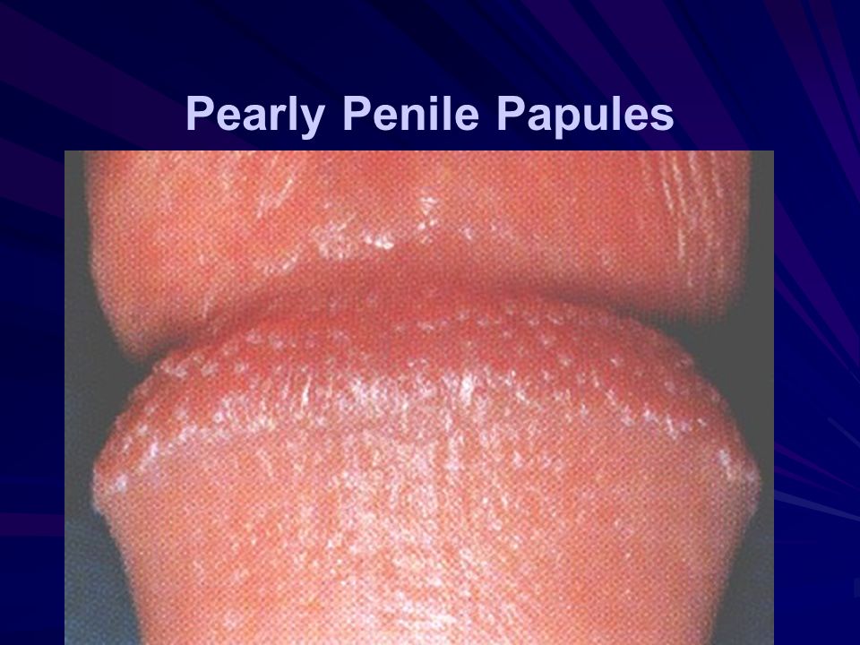Pearly Penile Papules Pearly penile papules are frequently found on the g.....