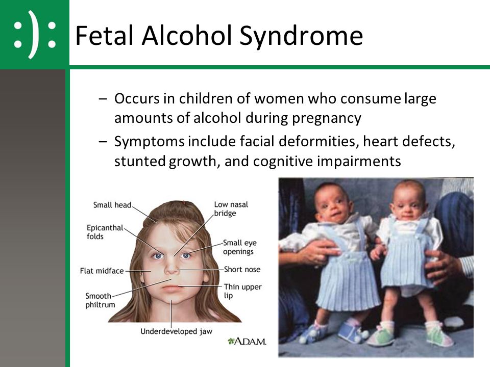 Fetal Alcohol Syndrome.