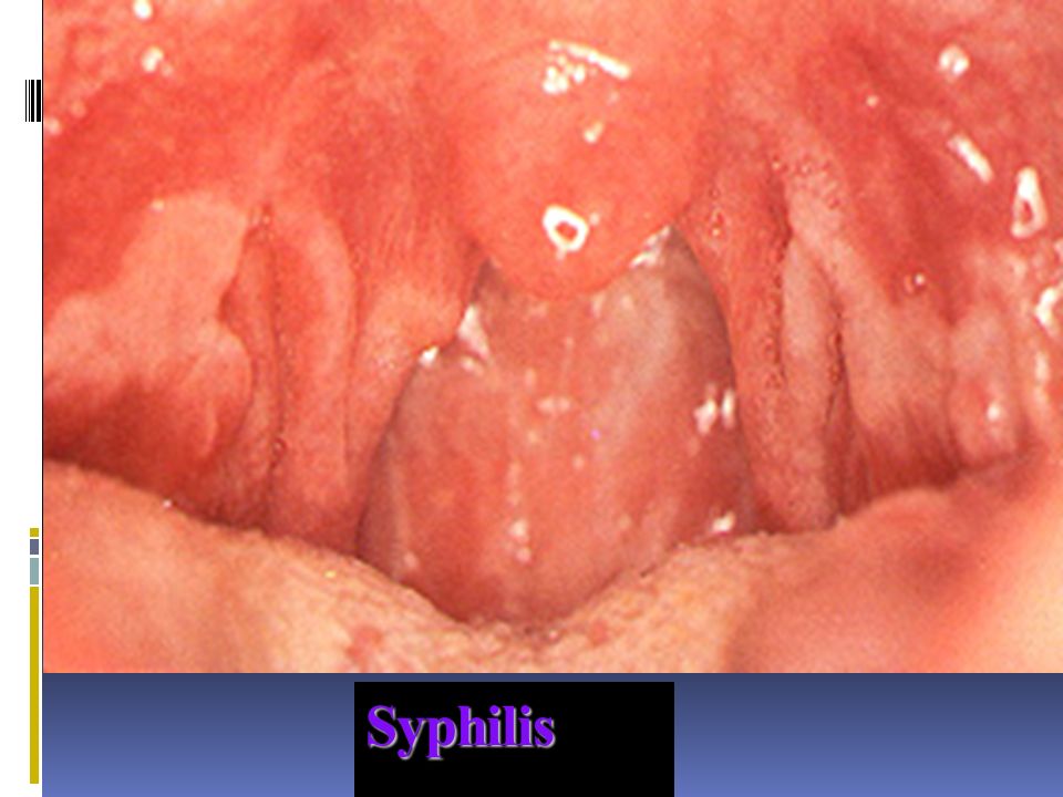 Snail-track ulcers of secondary syphilis.