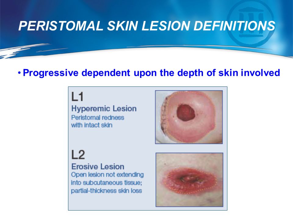 THE SACS™ INSTRUMENT ASSESSING AND CLASSIFYING PERISTOMAL SKIN LESIONS  Content Validated1 Welcome to this educational program on assessing and  classifying. - ppt video online download