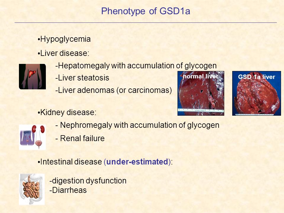 Phenotype of GSD1a Hypoglycemia Liver disease: