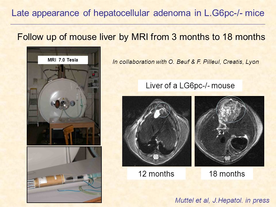 Late appearance of hepatocellular adenoma in L.G6pc-/- mice