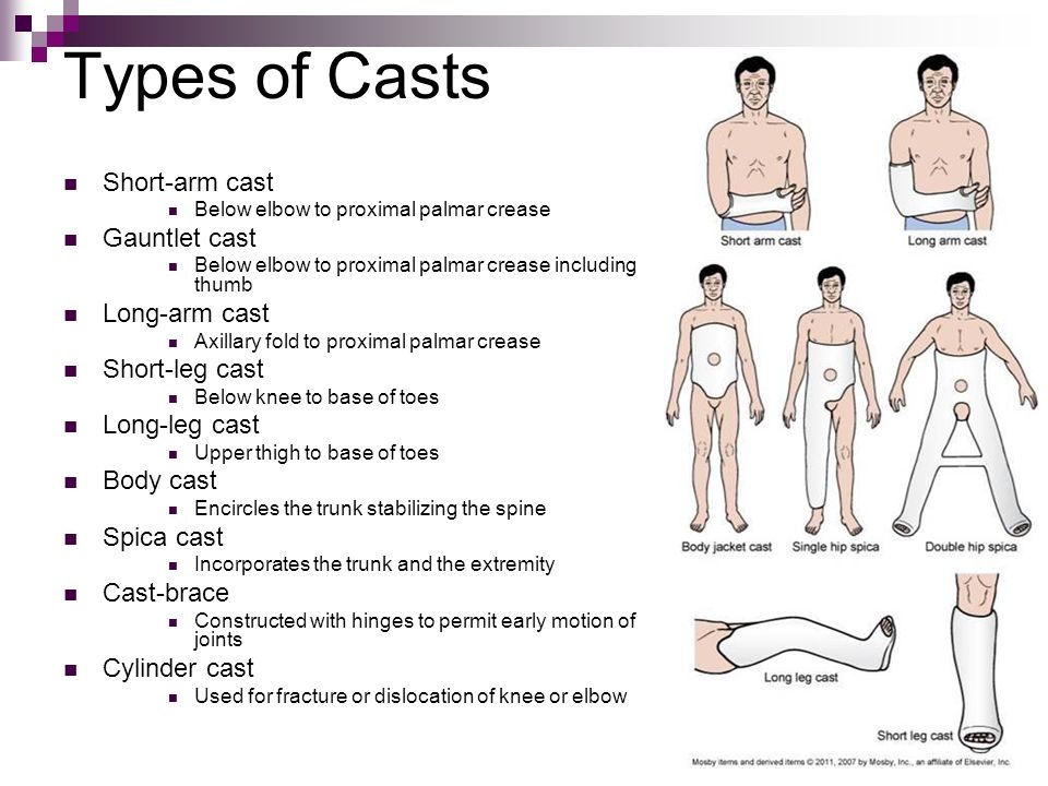 Casts, Care, and Compartment Syndrome - ppt video online download