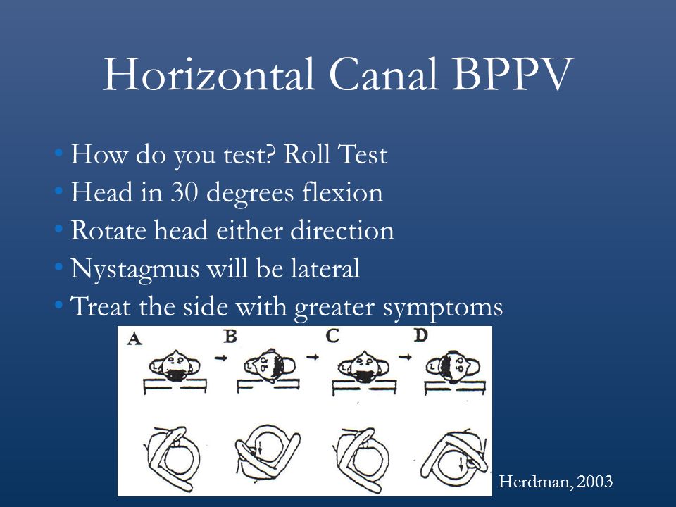 Horizontal Canal BPPV How do you test Roll Test