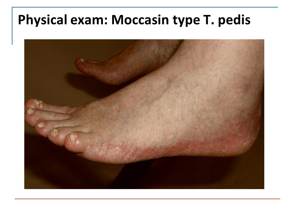Cutaneous Fungal Infections - ppt video online download