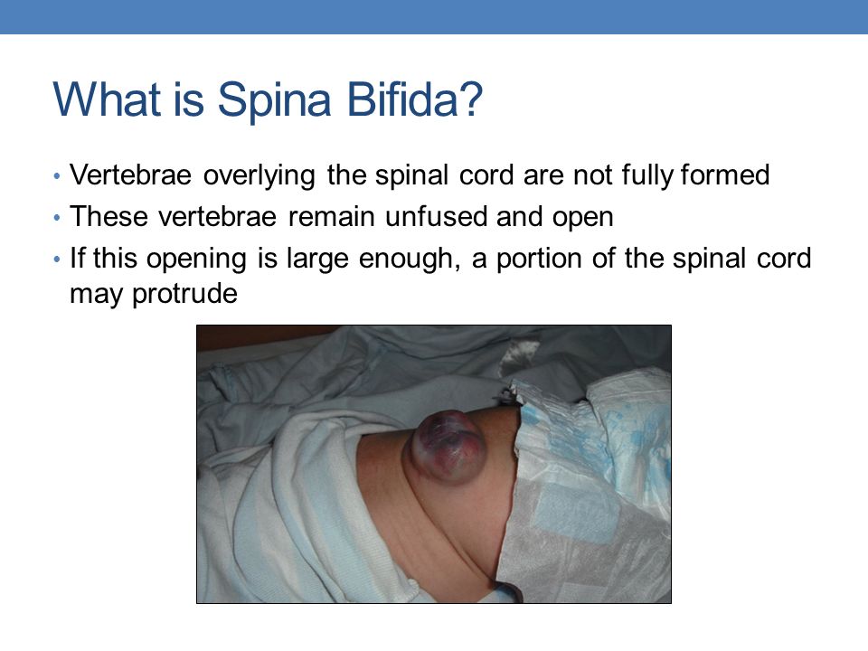 Nude Women With Spina Bifida
