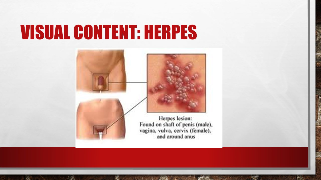 Genitalia herpes What is