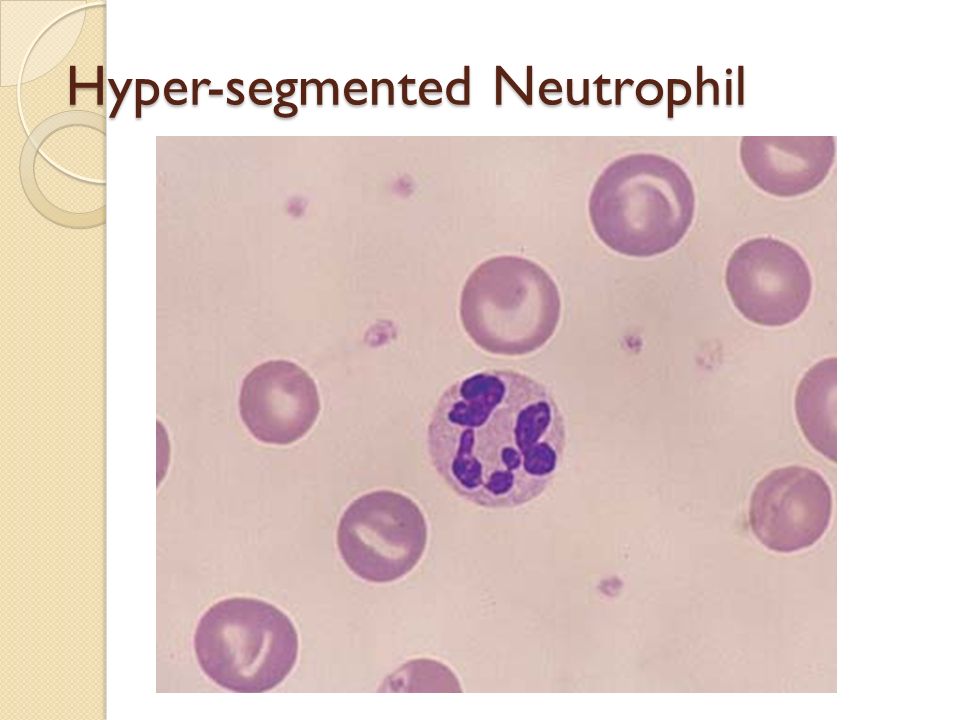 Hyper-segmented Neutrophil