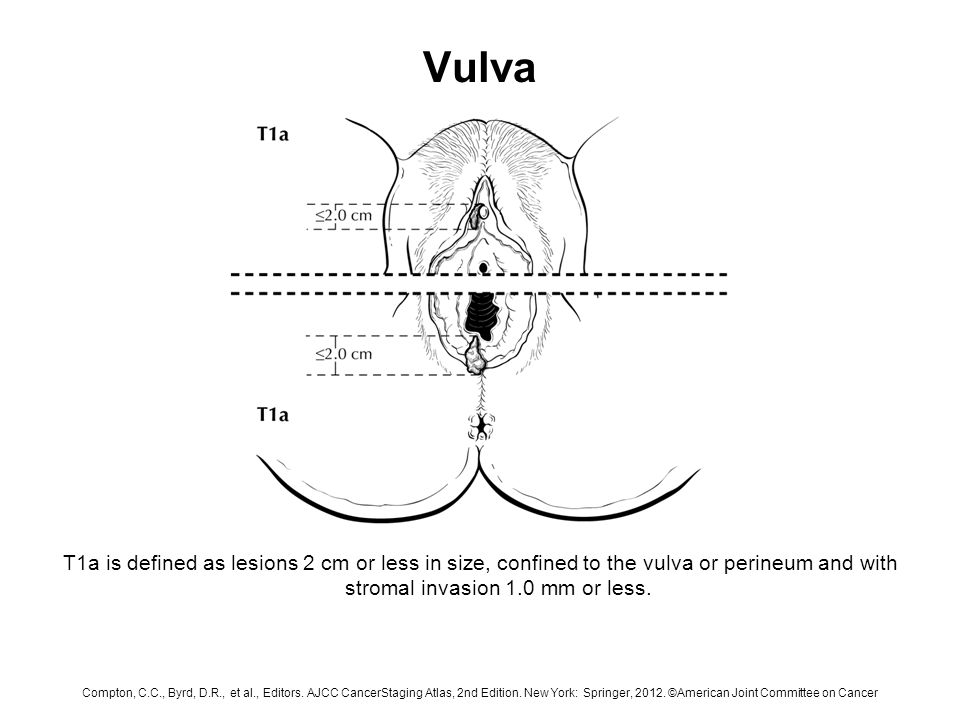 Vulva Affliction