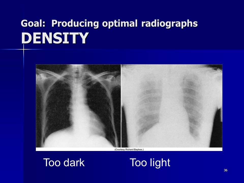 midlertidig Vurdering spild væk Components of Image Quality & Radiographic Artifacts - ppt video online  download