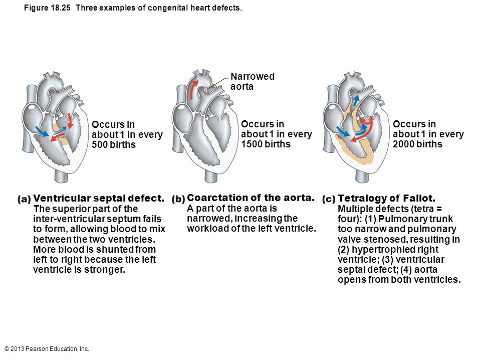 Figure Three examples of congenital heart defects.