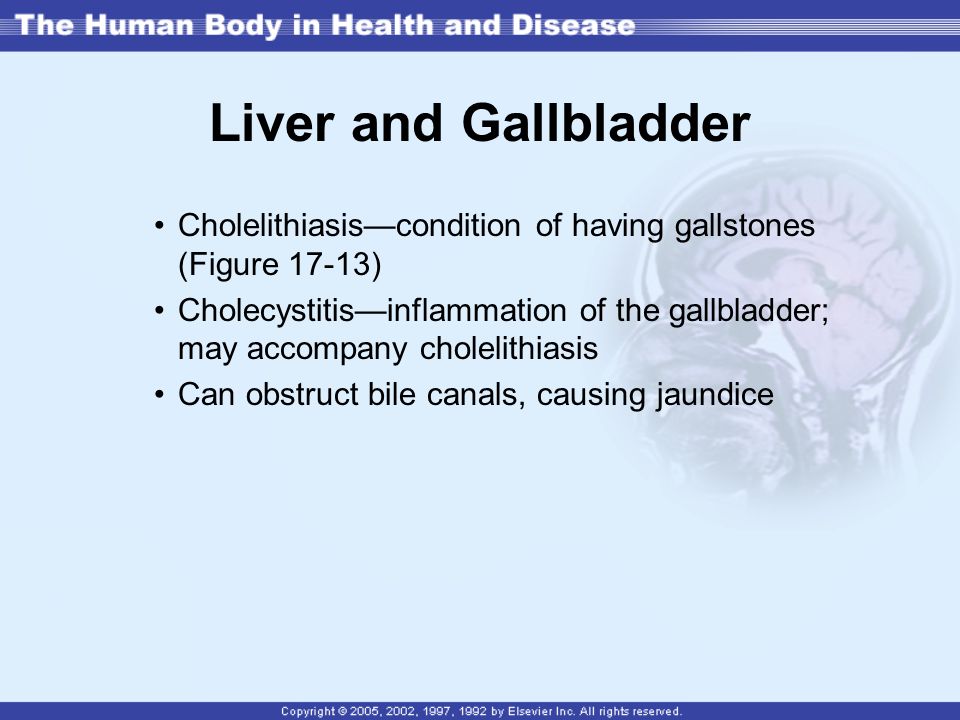 Liver and Gallbladder Cholelithiasis—condition of having gallstones (Figure 17-13)