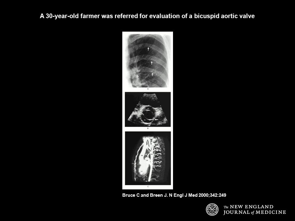 A 30-year-old farmer was referred for evaluation of a bicuspid aortic valve