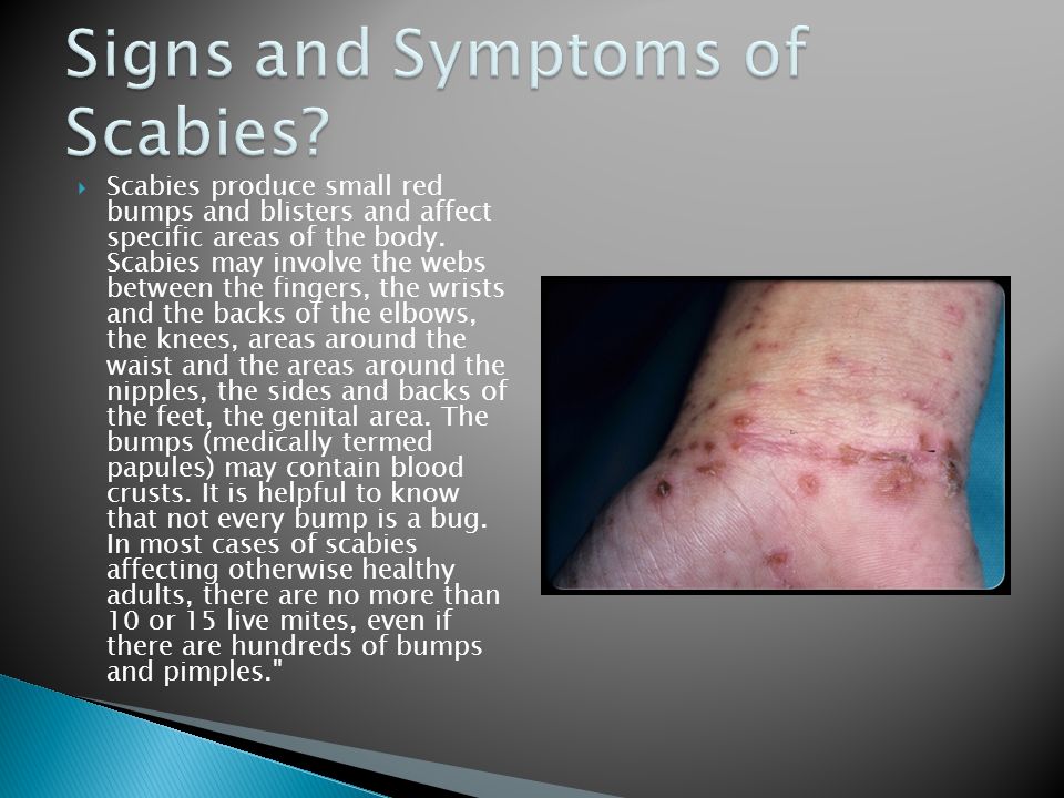 Signs and Symptoms of Scabies.