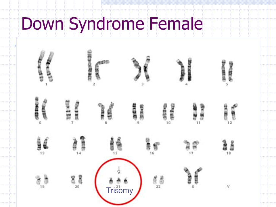 Кариотип синдрома дауна. Синдром Дауна хромосомная карта. Синдром Дауна кариотип. Кариотип при синдроме Дауна. Кариотип больного с синдромом Дауна.