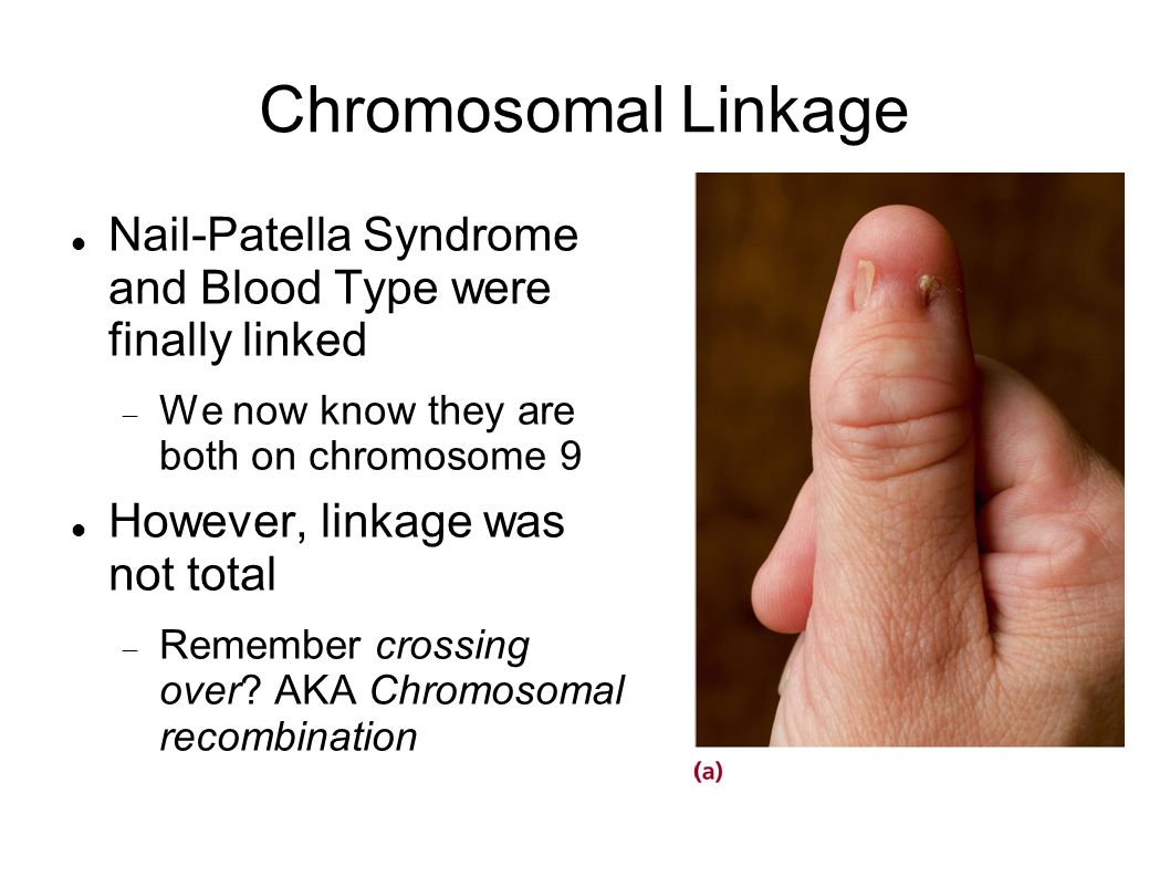 Chromosomal Linkage Nail-Patella Syndrome and Blood Type were finally linked. We now know they are both on chromosome 9.
