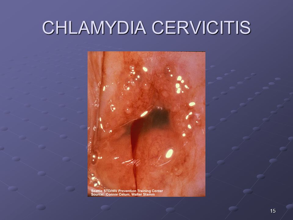 How Chlamydia Is Diagnosed