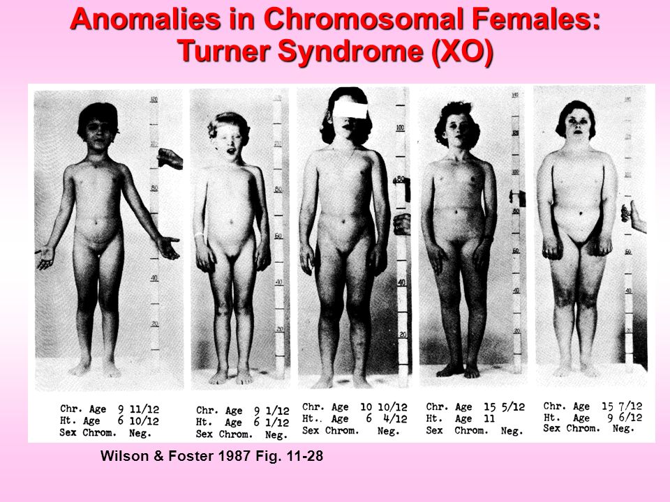Anomalies in Chromosomal Females: Turner Syndrome (XO) .