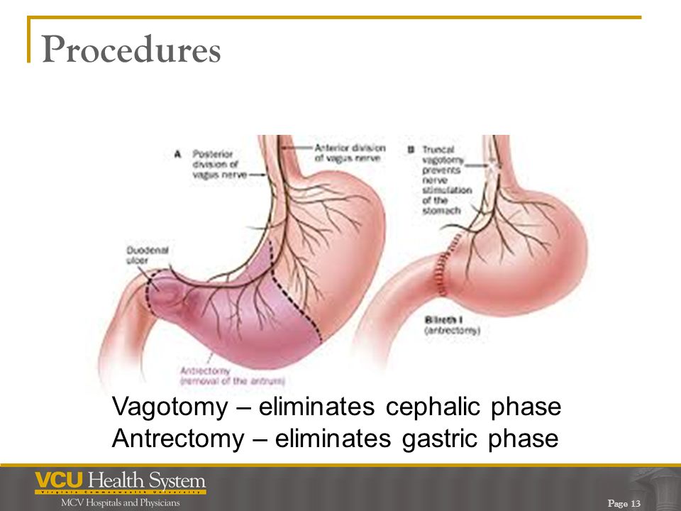 Procedures Vagotomy – eliminates cephalic phase