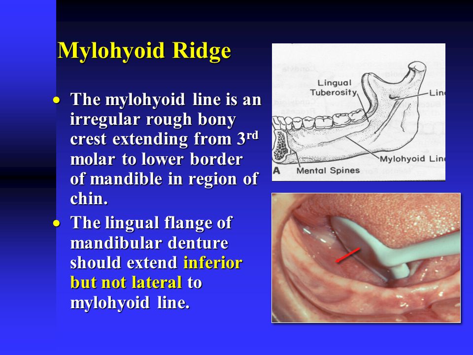 mylohyoid ridge denture