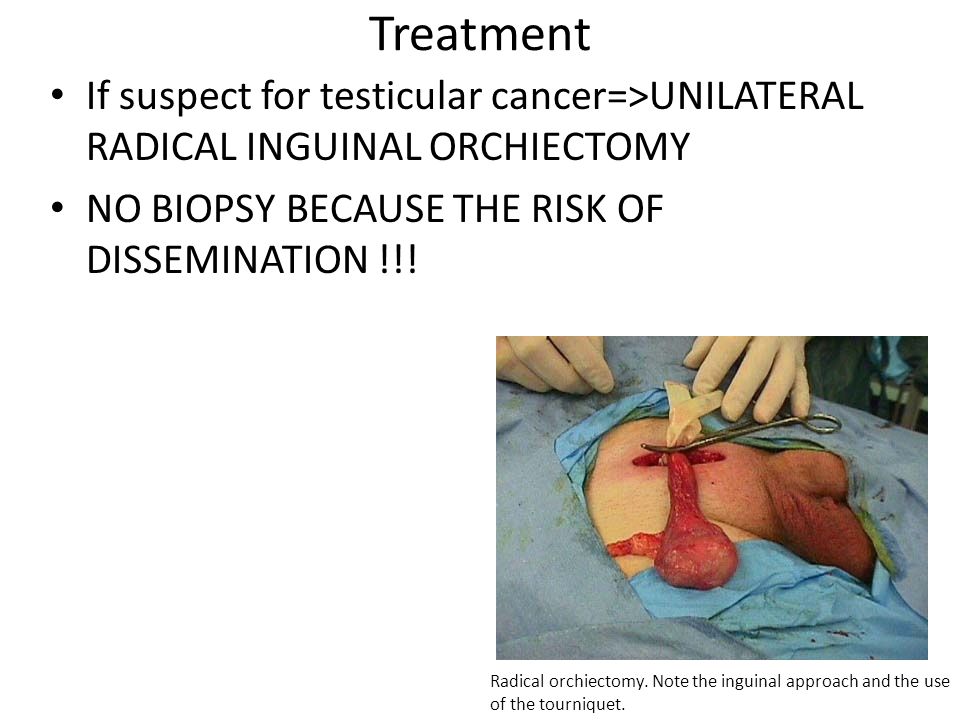 Treatment If suspect for testicular cancer=>UNILATERAL RADICAL INGUINAL ORCHIECTOMY. NO BIOPSY BECAUSE THE RISK OF DISSEMINATION !!!