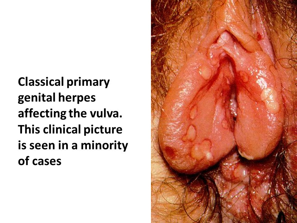 Vaginalis herpes Association between
