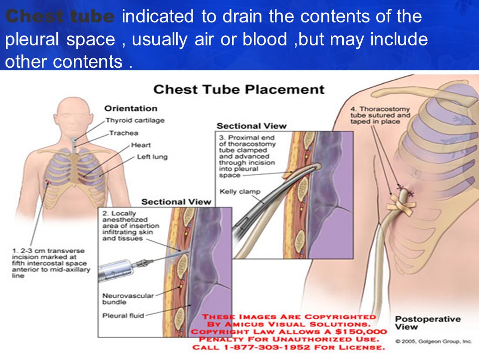 Chest tube indicated to drain the contents of the pleural space , usually a...