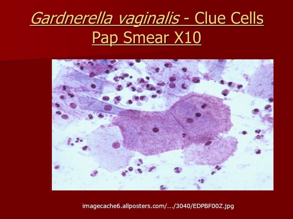 Gardnerella vaginalis - Clue Cells Pap Smear X10.