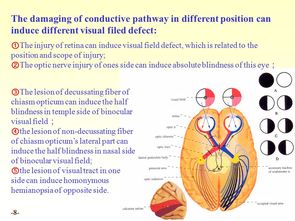 The damaging of conductive pathway in different position can induce different visual filed defect: