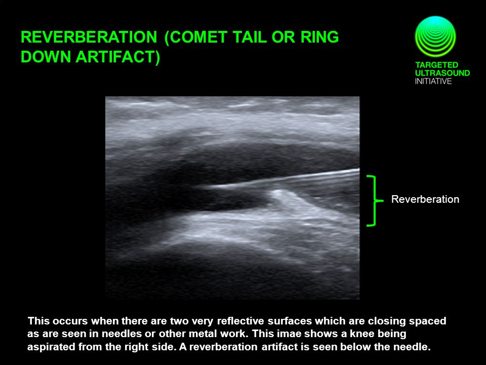Ring down artifact | Radiology Reference Article | Radiopaedia.org
