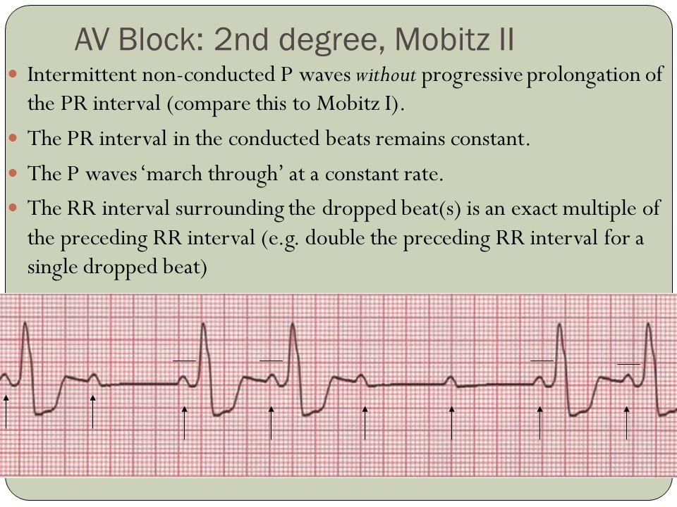 AV Blocks Bundle Branch Blocks - ppt video online download