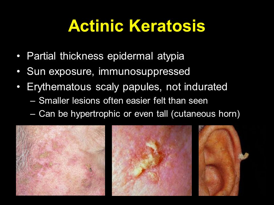 actinic keratosis horn