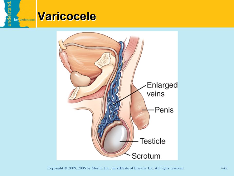 Varicocele What type of body part is the scrotum.