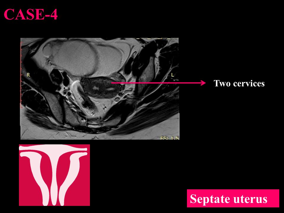 CASE-4 Two cervices Septate uterus